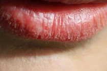 Người có gan xấu thường có 4 biểu hiện trên môi