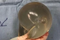 Thấy nóng trong ngực, cô gái mới phát hiện mình bị đạn bắn từ lúc nào