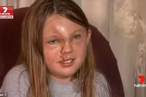 Con gái bị hủy hoại gương mặt sau tai nạn thảm khốc