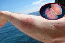 Cách xử lý đúng đắn khi đi tắm biển bị sữa tấn công