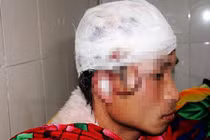 Nghệ An: Giả chết vẫn bị gấu rừng tát rách đầu