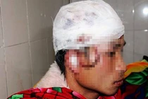 Nghệ An: Giả chết vẫn bị gấu rừng tát rách đầu