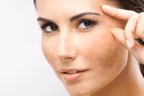 Bí quyết trị nám hiệu quả, giúp chị em luôn tỏa sáng