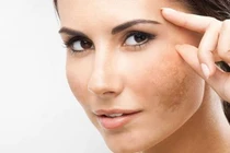 Bí quyết trị nám hiệu quả, giúp chị em luôn tỏa sáng