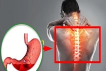 Nguy hiểm khi dùng thuốc giảm đau xương khớp ở người tiền sử bệnh dạ dày