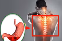 Nguy hiểm khi dùng thuốc giảm đau xương khớp ở người tiền sử bệnh dạ dày