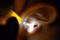 Hãi hùng thiếu nữ bị gián chui vào tai, cắn thủng màng nhĩ