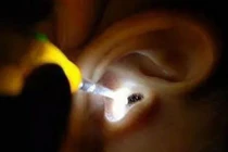 Hãi hùng thiếu nữ bị gián chui vào tai, cắn thủng màng nhĩ