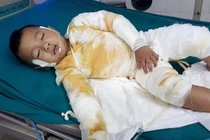 Bé 4 tuổi khóc thét vì ngã vào nồi nấu rượu