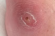 Nhiềm trùng máu: Căn bệnh có thể gây tử vong chỉ sau vài giờ