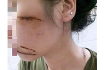 Hải Dương: Nữ nhân viên spa bị nhóm côn đồ chém trọng thương