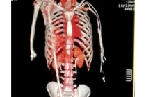 Bị thanh thép xuyên từ háng tới cổ, người đàn ông thoát chết ngoạn mục