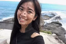 Cô gái có hàng trăm nốt ruồi gây bất ngờ khi thi HH Hoàn vũ