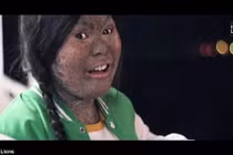 Xót xa cô bé 17 tuổi mắc bệnh hiếm, da lột như rắn