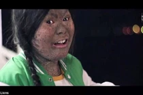 Xót xa cô bé 17 tuổi mắc bệnh hiếm, da lột như rắn