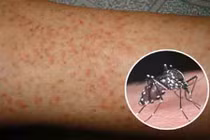 Những hiểu lầm tai hại của người dân về sốt xuất huyết