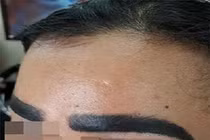 Sẹo lồi, lõm như “ổ trâu, ổ gà” trên mặt vì thích xăm vô tội vạ