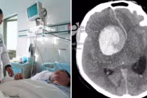 8 kiểu đau đầu là do bệnh nguy hiểm, liên quan đến mạch máu não