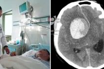 8 kiểu đau đầu là do bệnh nguy hiểm, liên quan đến mạch máu não