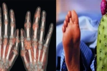 Căn bệnh "nhà giàu" gây đau đớn, mất ăn mất ngủ