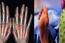 Căn bệnh "nhà giàu" gây đau đớn, mất ăn mất ngủ