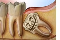 Video: Sự tích răng khôn và vì sao chúng hành hạ con người đến vậy?