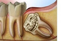 Video: Sự tích răng khôn và vì sao chúng hành hạ con người đến vậy?