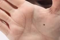 Có 1 nốt ruồi này năm 2022 tài lộc ùa đến chật ví