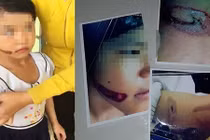 Bé gái nghi bị bố và mẹ kế dí sắt nung vào mặt đã bỏ học