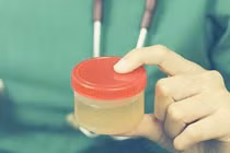 Nước tiểu màu sẫm báo hiệu bệnh gì?