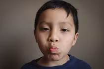  Cách nhận biết sớm đột quỵ não