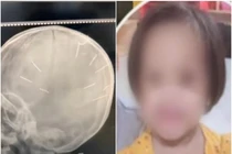 Vì sao gã “cha dượng” đóng đinh đầu bé 3 tuổi ở Hà Nội?