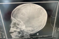 Bé 3 tuổi nghi bị bạo hành, 9 dị vật găm ở đầu: Cần khởi tố vụ án 