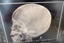 Bé 3 tuổi nghi bị bạo hành, 9 dị vật găm ở đầu: Cần khởi tố vụ án 