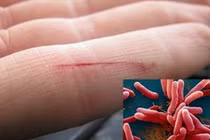 Thanh Hóa: Ghi nhận trường hợp mắc “khuẩn ăn thịt người” chưa rõ nguồn