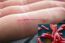 Thanh Hóa: Ghi nhận trường hợp mắc “khuẩn ăn thịt người” chưa rõ nguồn