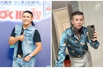 Kasim Hoàng Vũ thay đổi không nhận ra sau phẫu thuật xương hàm