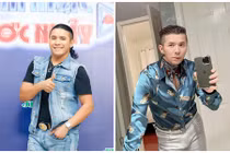 Kasim Hoàng Vũ thay đổi không nhận ra sau phẫu thuật xương hàm