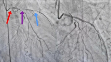 Bệnh nhân hai lần ngừng tim được cứu sống nhờ can thiệp kịp thời