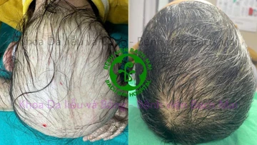 Chăm sóc tóc đúng cách, tránh tổn thương nang tóc lâu dài