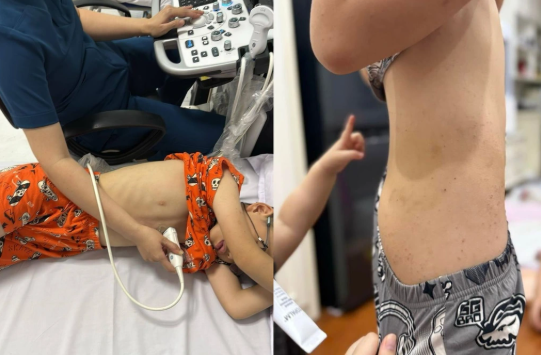 Con trai chị L. về mẩn ngứa khắp người, bị bạn đạp vào bụng, được chị đưa đi thăm khám. lhf.png