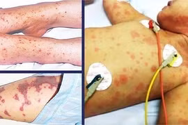 Trẻ em là đối tượng dễ mắc não mô cầu