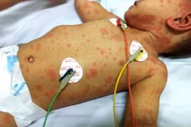 Bệnh nhân mắc bệnh viêm màng não mô cầu.