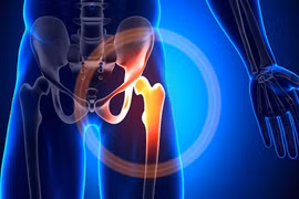 Thoái hóa khớp khiến cho người bệnh đau đớn khi đi lại