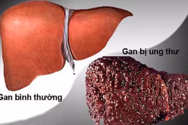 Ung thư gan có thể di căn tới nhiều cơ quan trên cơ thể.