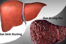 Ung thư gan có thể di căn tới nhiều cơ quan trên cơ thể.