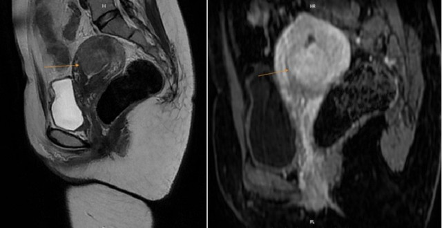 MRI phát hiện một khối u ở trong buồng tử cung của bệnh nhân. Ảnh BVCC hinh-anh-sieu-am1.jpg