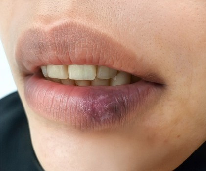 Tưởng khô môi, dị ứng đi khám mắc lupus ban đỏ dạng đĩa. Ảnh BVCC mai.jpg