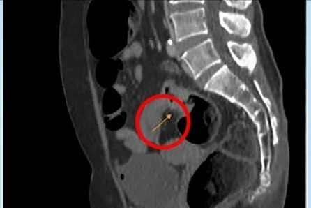 Chụp MRI cho thấy khối u ở trực tràng (mũi tên vàng) của bệnh nhân. Ảnh BVCC khoi-u-truc-trang-3567.jpg
