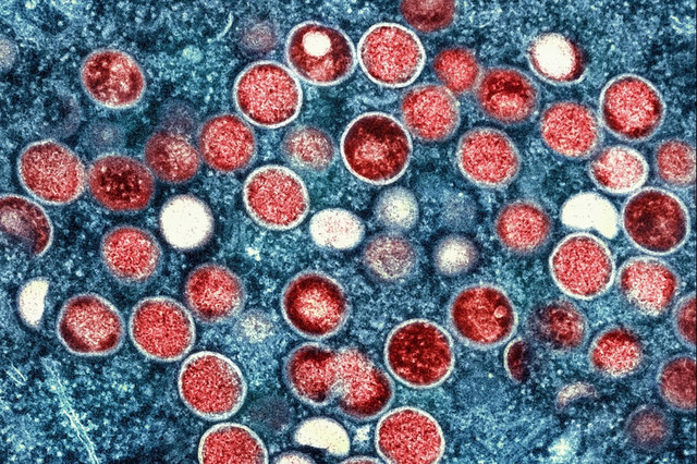 Người nhiễm virus Mpox gây bệnh đậu mùa khỉ nên đi xét nghiệm HIV Nguoi nhiem virus Mpox gay benh dau mua khi nen di xet nghiem HIV